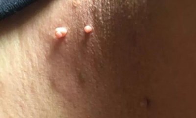 ​身上长小肉粒可以抠掉吗？小肉粒“偏爱”这些人