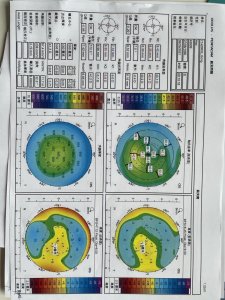 ​犹豫了两年之后，我终于做了全飞秒近视矫正手术，还是有点后悔的