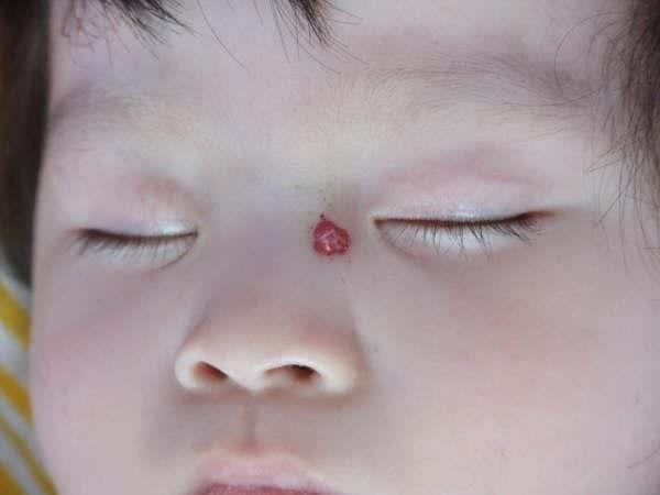 红痣与血痣（红痣是什么原因）