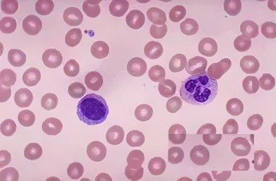 ​NKT细胞——人体的守护天使