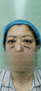 ​提眉术后1-7天照片，55岁女士提眉案例告诉你术后的恢复情况