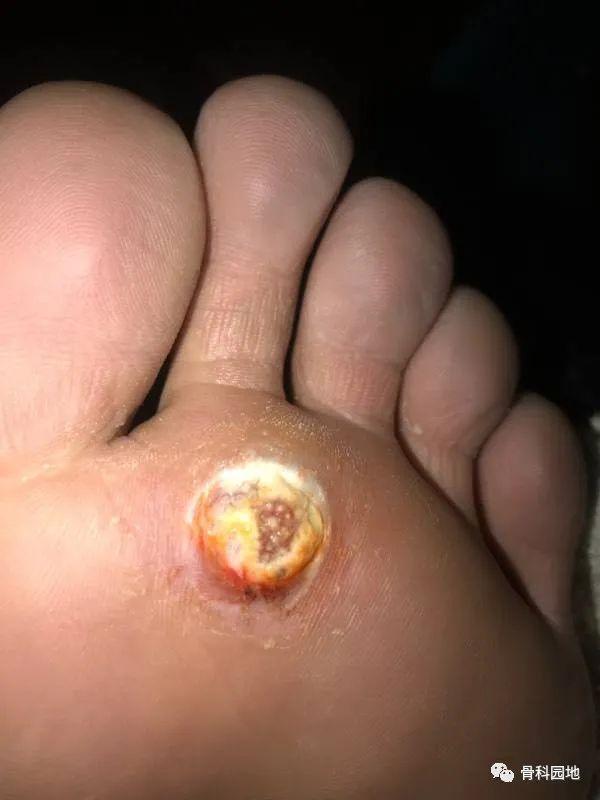 鸡眼的横切面（足底的肉刺你了解吗）(1)