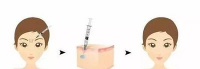 ​如何去掉眉心皱纹(眉心的皱纹怎么去掉)