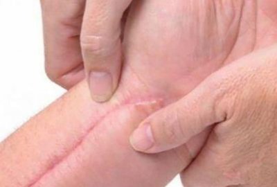 ​这么久了才知道!原来这种才是疤痕体质!