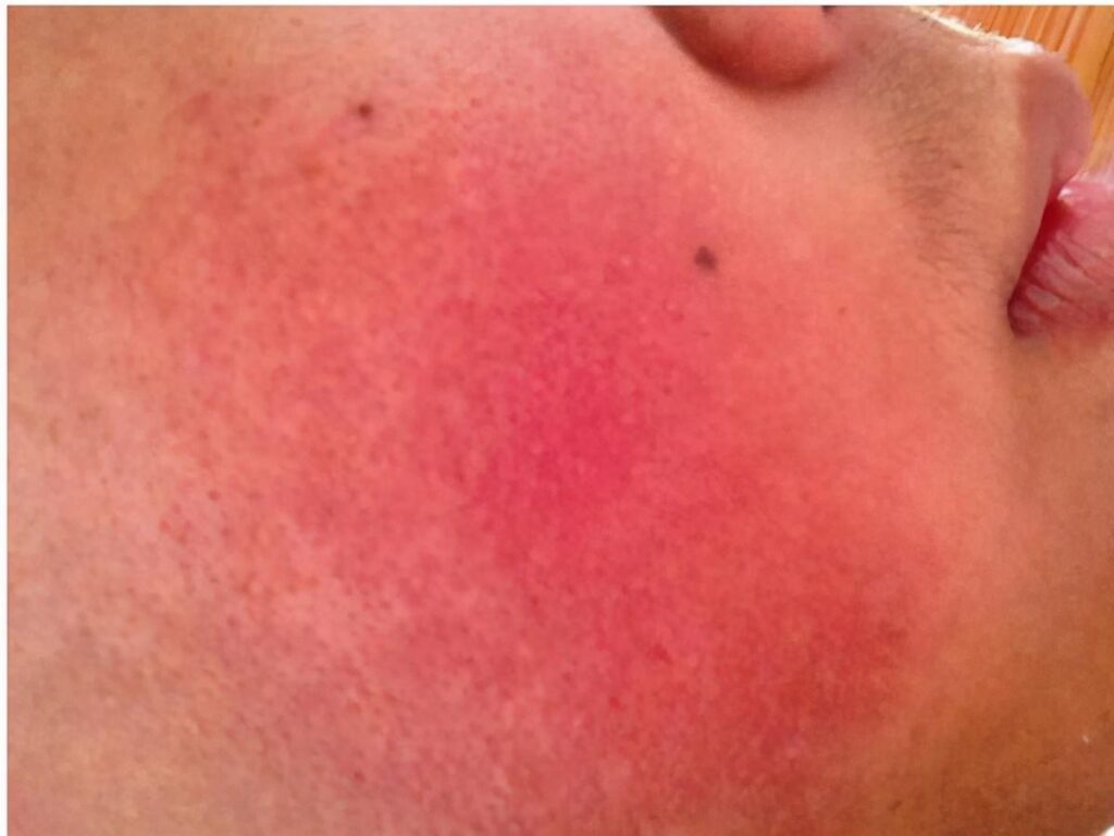 治疗红血丝需要的费用是多少_影响价格的因素