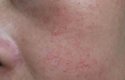 ​治疗红血丝需要的费用是多少_影响价格的因素