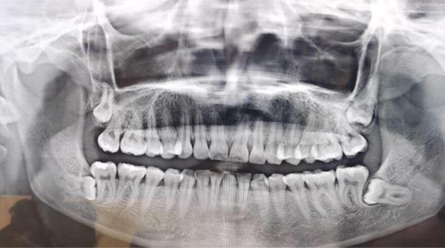 生活长出智齿的原因是什么?智齿会造成哪些问题?  1