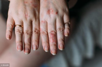 ​湿疹吃什么 大人小孩都能喝！5款祛湿疹汤水，让你远离湿疹烦恼！