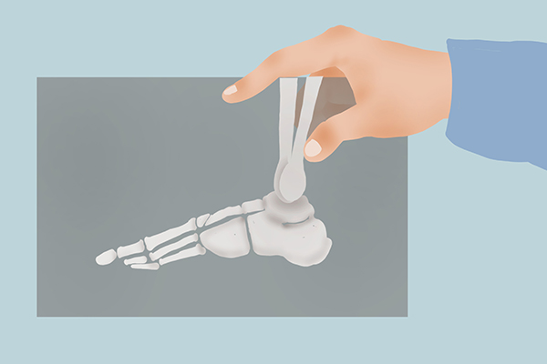 小脚趾甲两瓣的原因（小脚趾指甲分成两瓣对健康的影响）