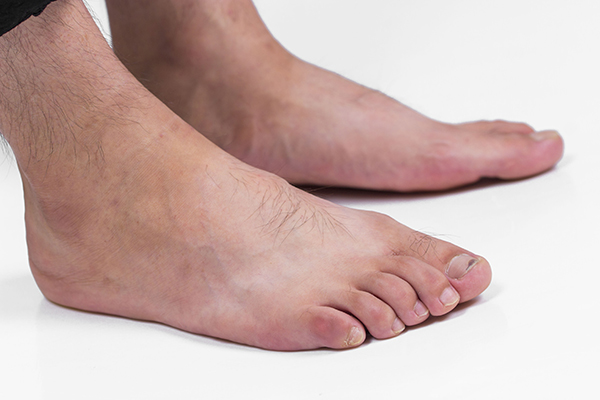 小脚趾甲两瓣的原因（小脚趾指甲分成两瓣对健康的影响）